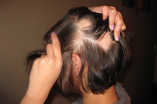 Types of Alopecia