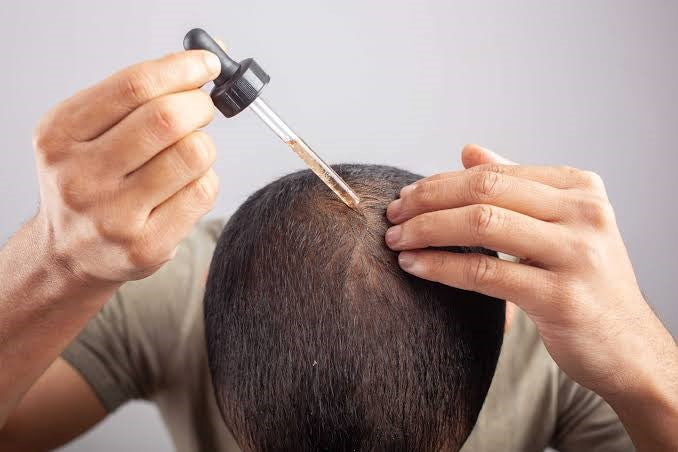 Treating Alopecia Using Minoxidil – The Side Effects